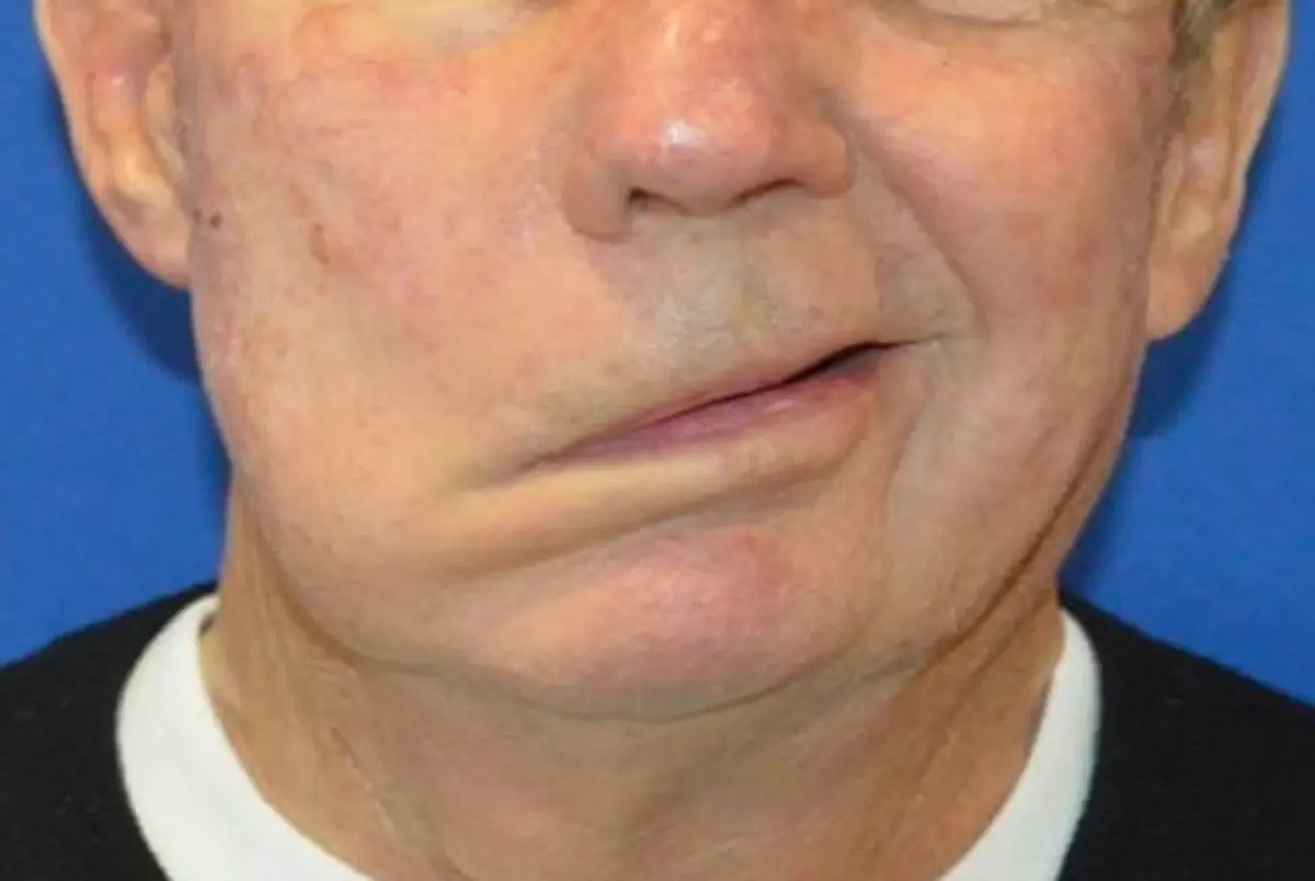 فلج بل چیست